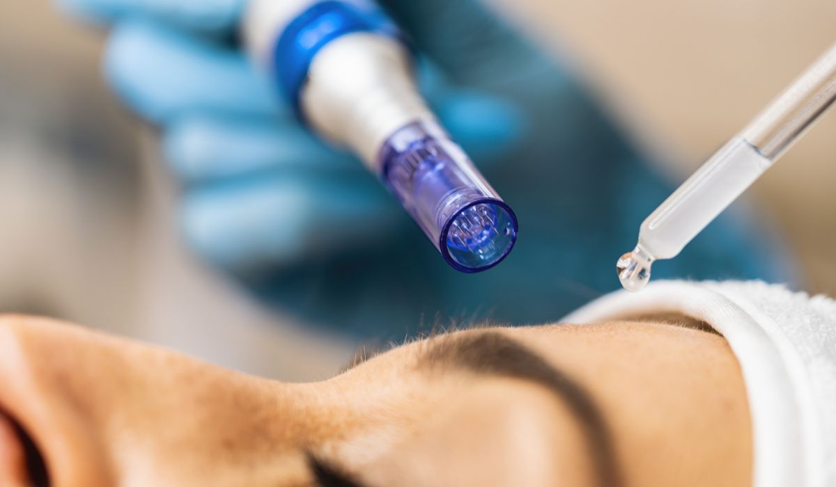 ace de unica folosinta microneedling