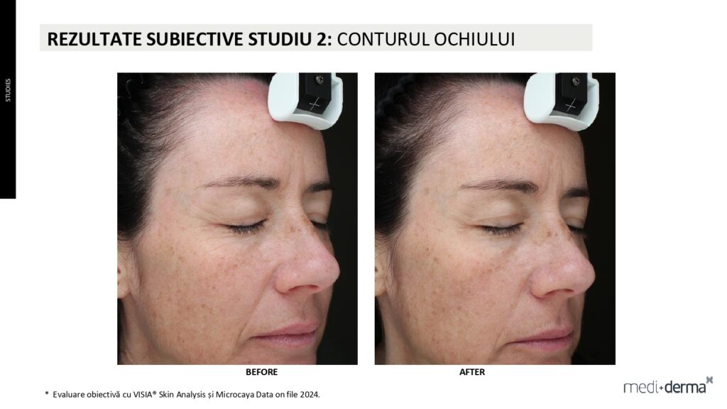 salon cosmetica sibiu global filler fillderma 1