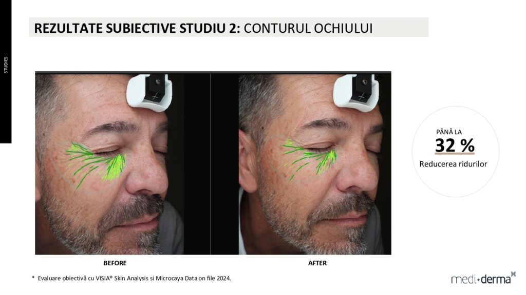 salon cosmetica sibiu global filler fillderma 2