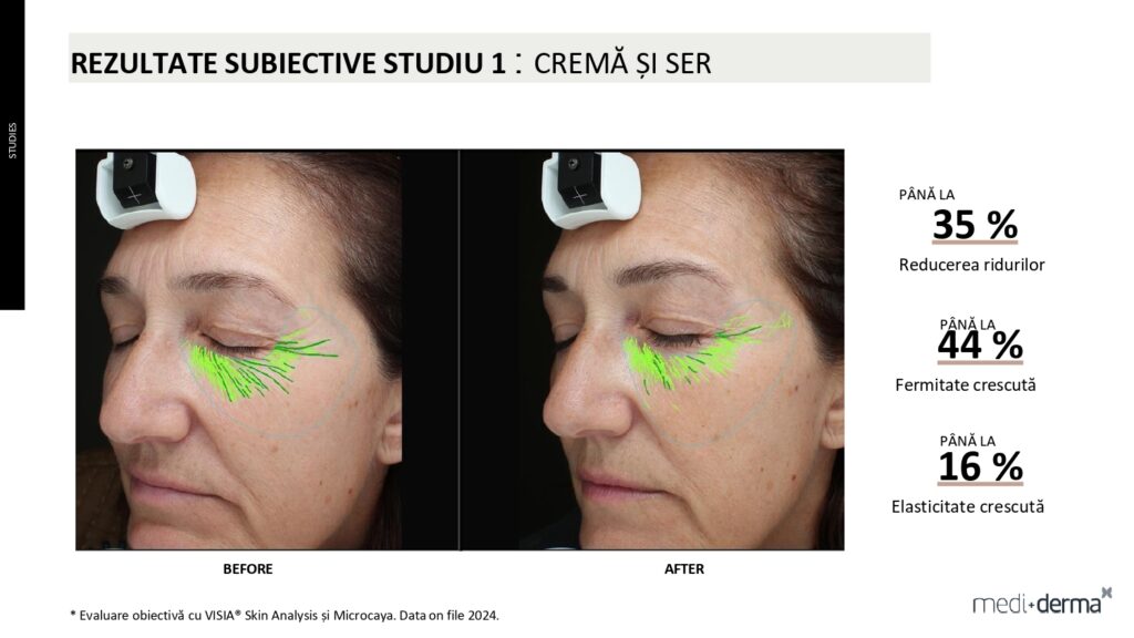salon cosmetica sibiu global filler fillderma 23