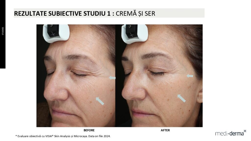 salon cosmetica sibiu global filler fillderma 24