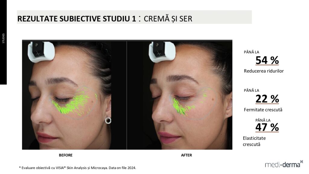 salon cosmetica sibiu global filler fillderma 25