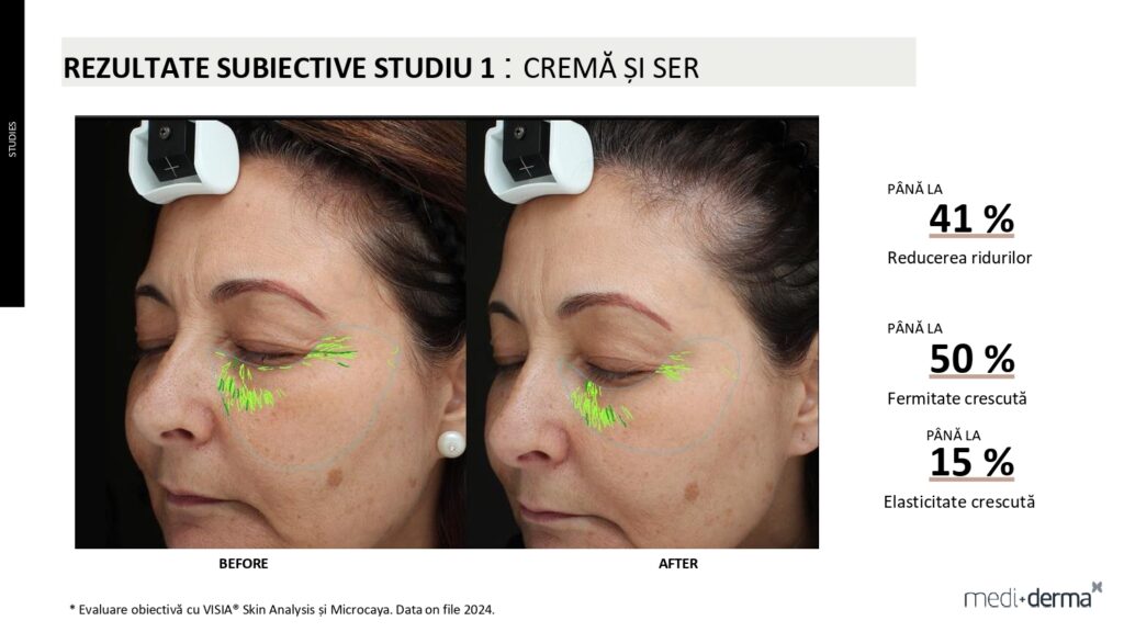 salon cosmetica sibiu global filler fillderma 26