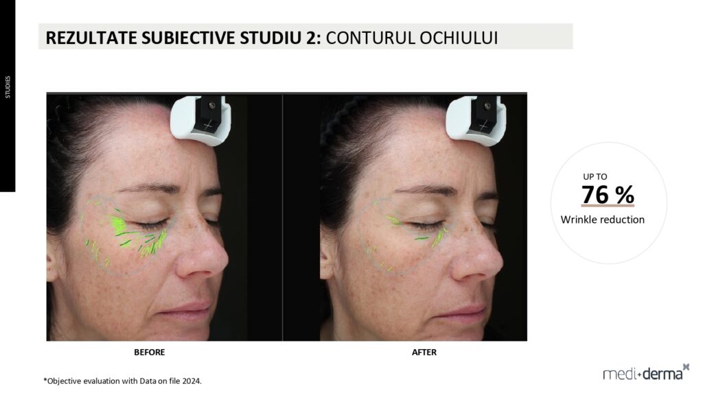 salon cosmetica sibiu global filler fillderma 28