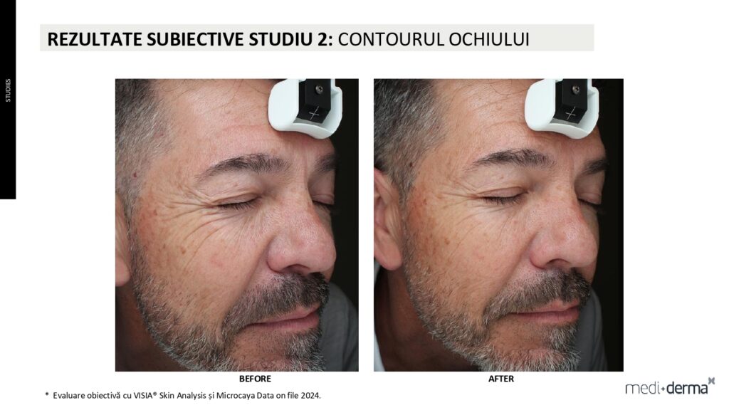 salon cosmetica sibiu global filler fillderma 3