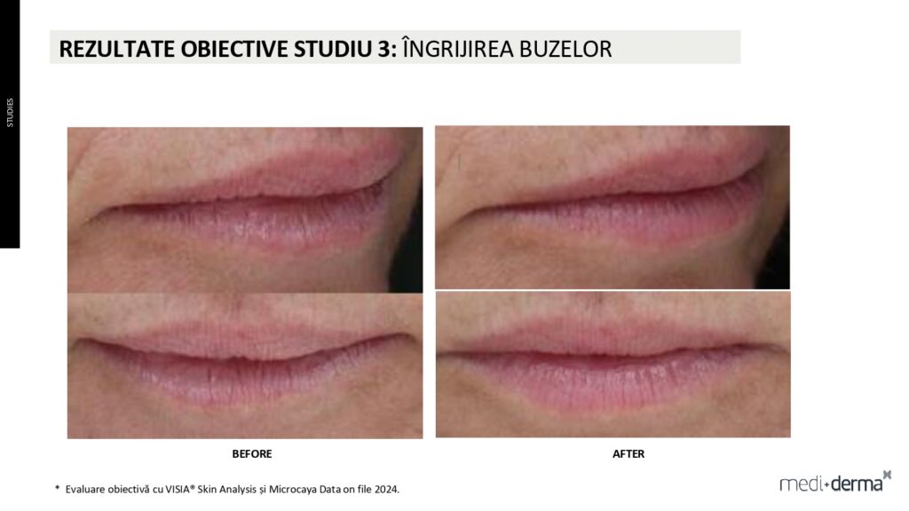 salon cosmetica sibiu global filler fillderma 4