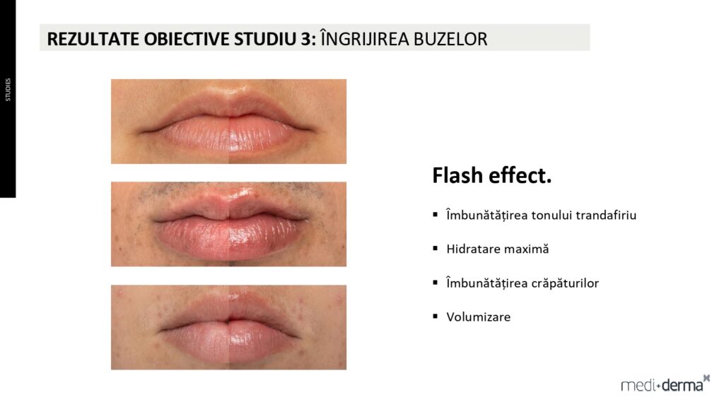 salon cosmetica sibiu global filler fillderma 5