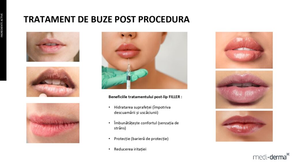 salon cosmetica sibiu global filler fillderma 8