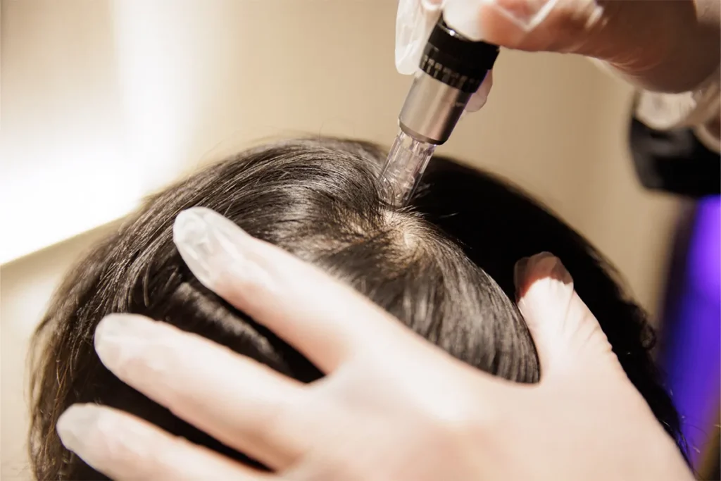 microneedling scalp cu exozomi sibiu