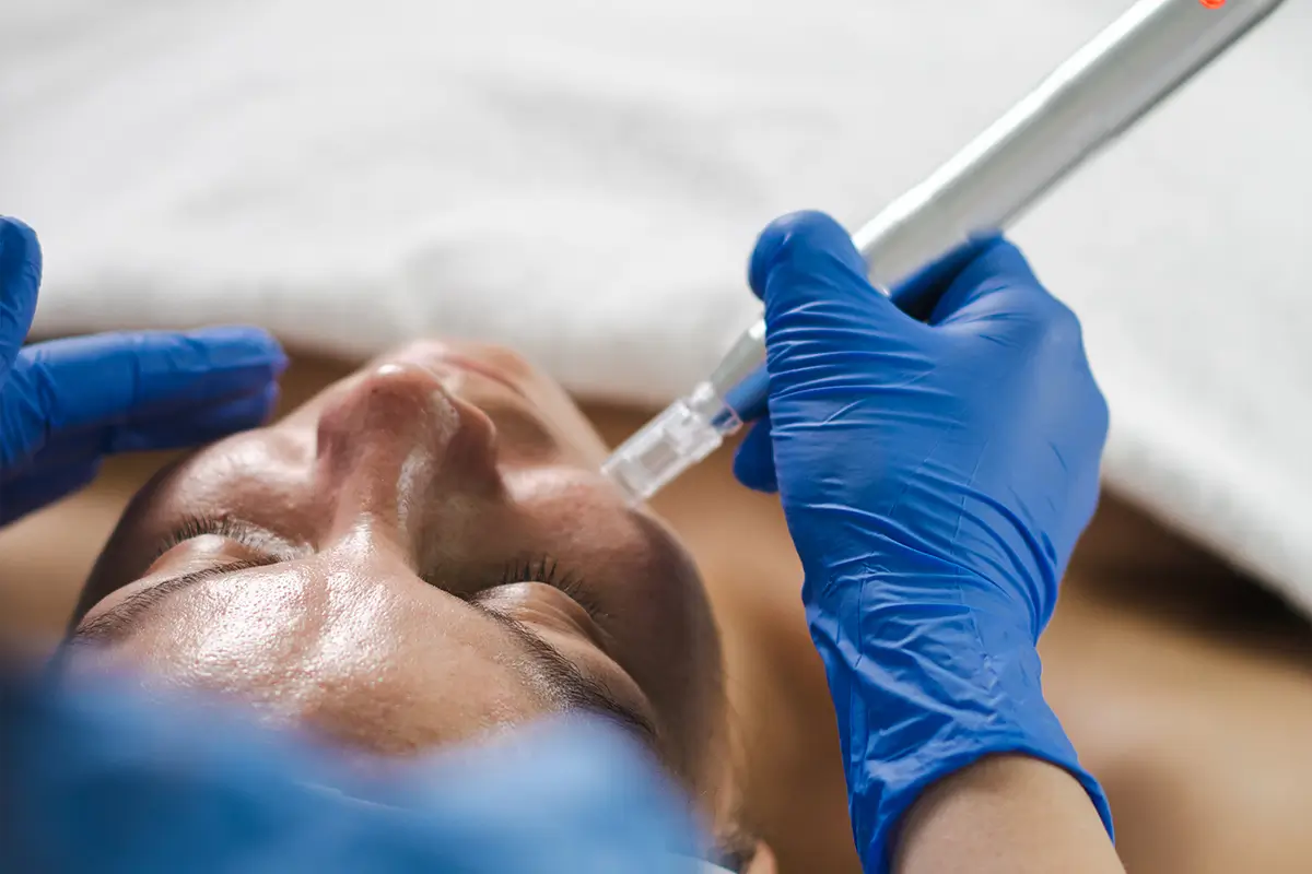 microneedling tratament sibiu